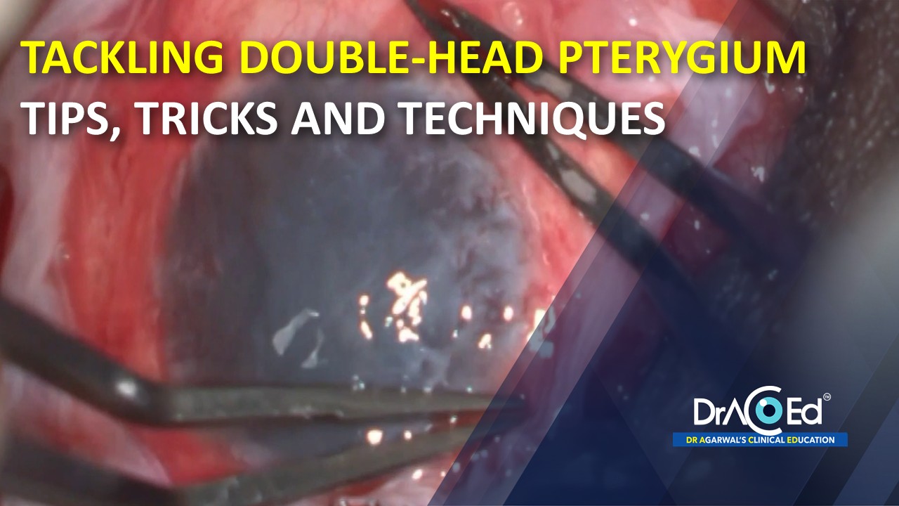 TACKLING DOUBLE-HEAD PTERYGIUM : TIPS, TRICKS AND TECHNIQUES